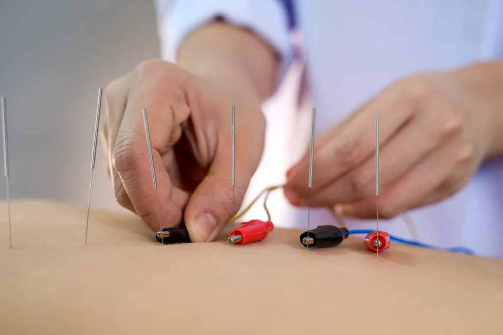 electro-acupuncture-body-patient electro-acupuncture-body-patient